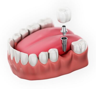 amazing benefits of getting dental implants