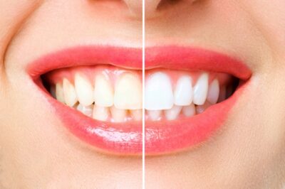 the truth about teeth whitening