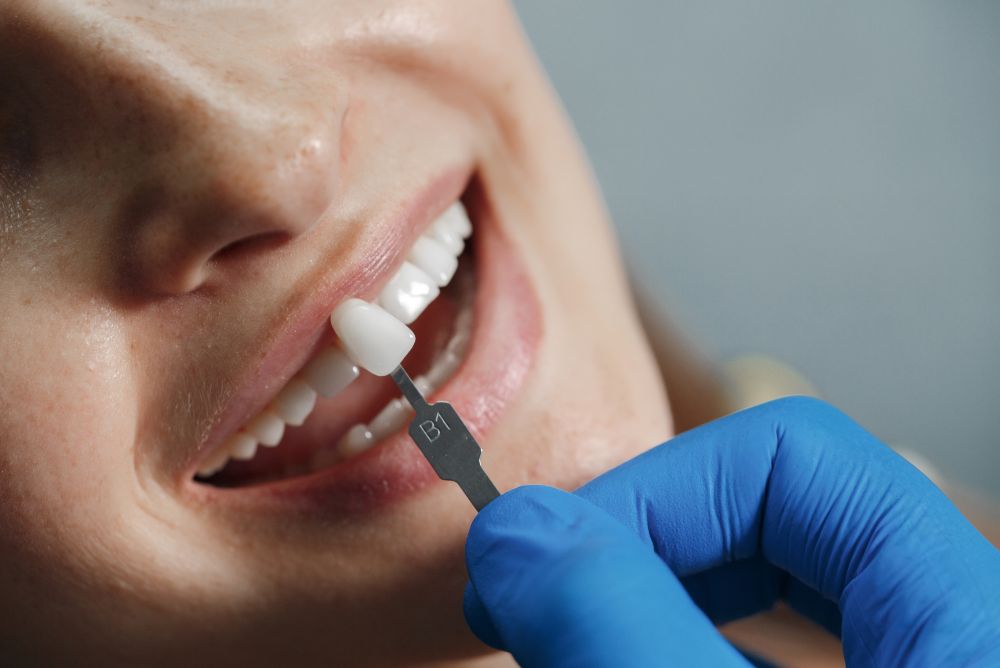 Dental Bridges
