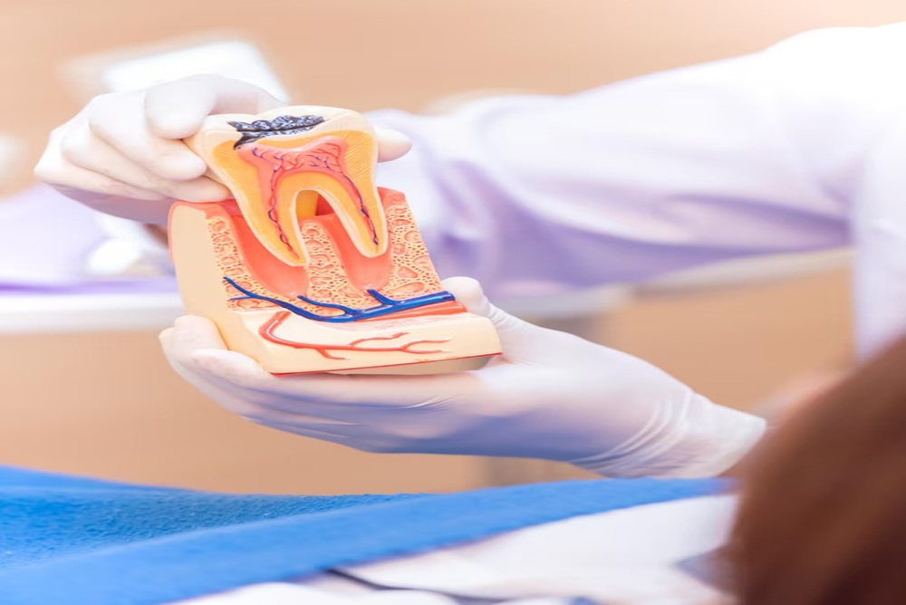 Root Canal