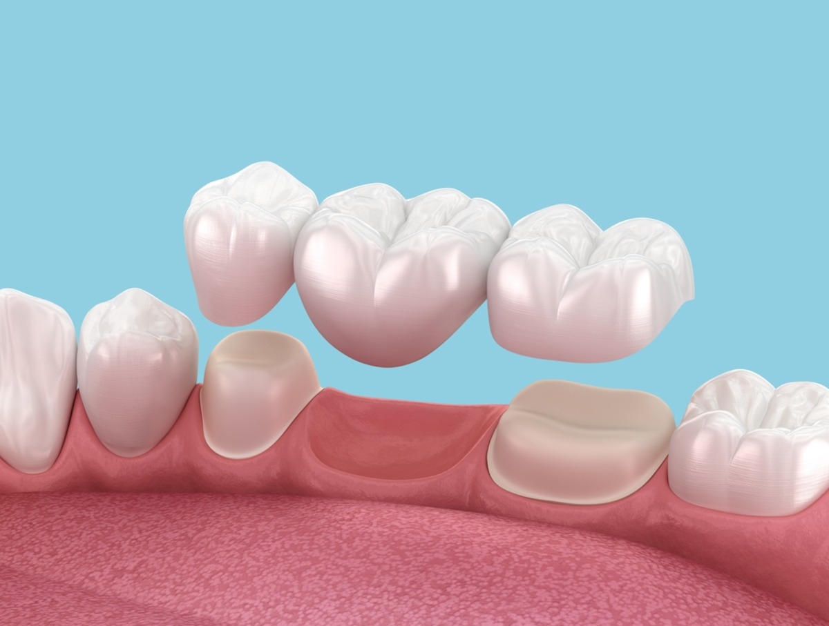 causes of a loose dental bridge